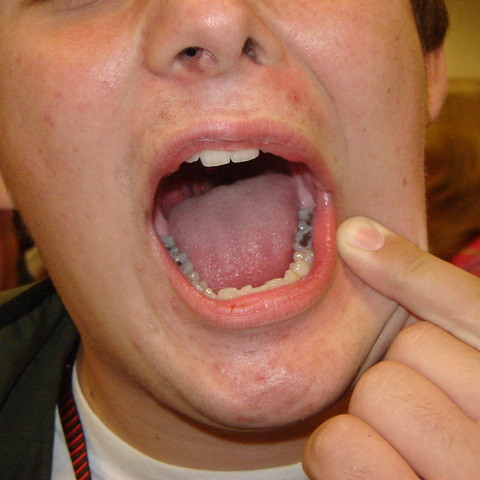 Gold Tooth?
